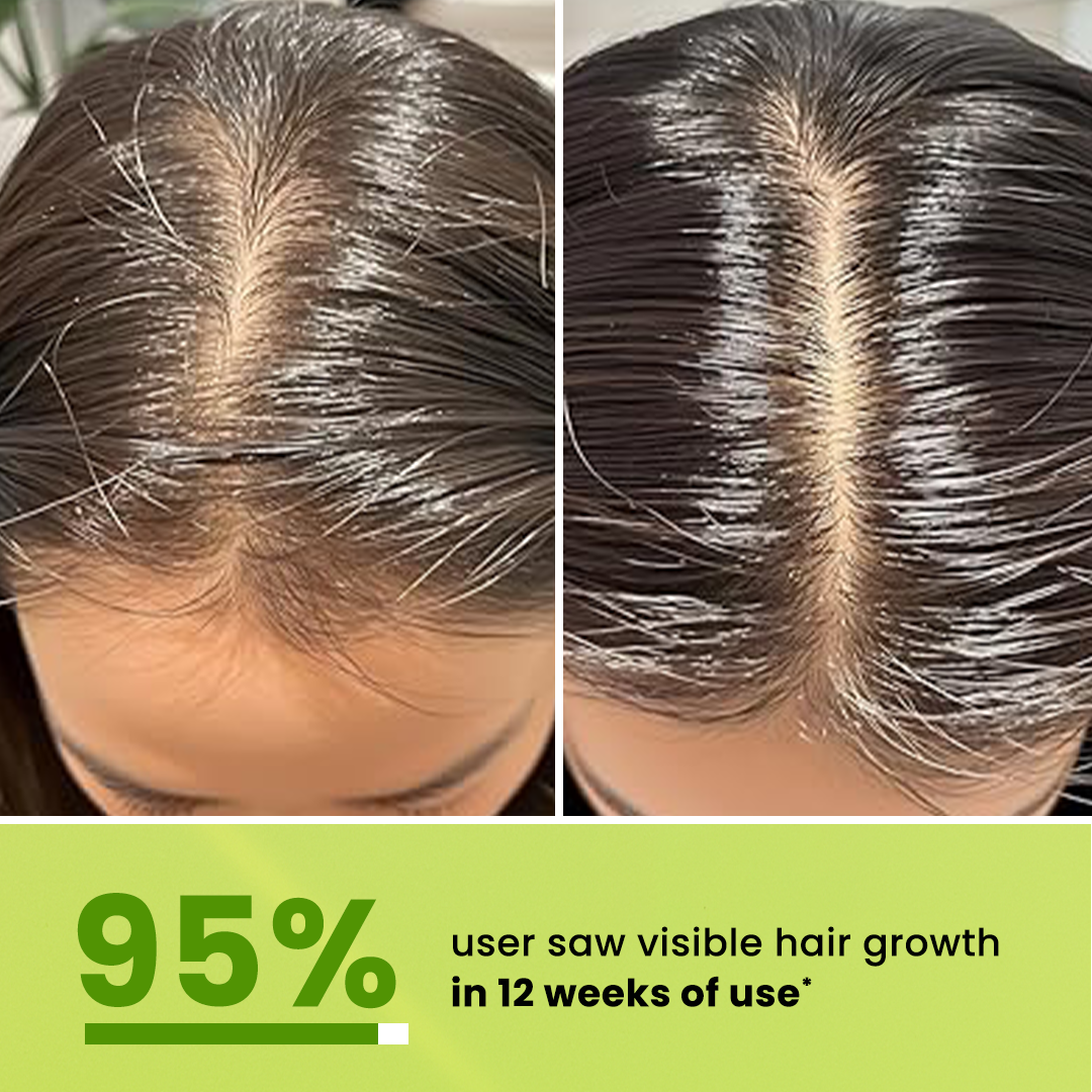 Advanced Hair Growth Serum Roll On ( 10X Faster Results )
